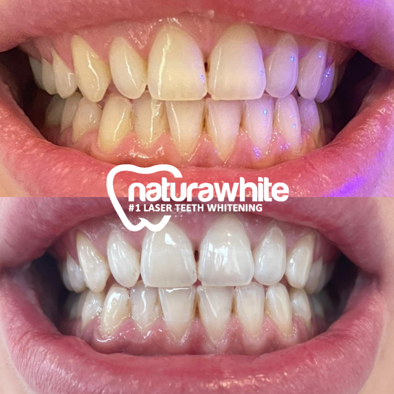 Teeth whitening in Sunderland